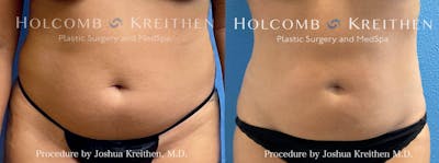 Liposuction Before & After Gallery - Patient 242346 - Image 1