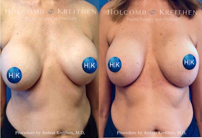 Breast Implant Exchange Before & After Gallery - Patient 708932 - Image 1