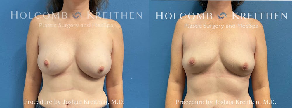 Breast Implant Removal Before & After Gallery - Patient 217308 - Image 1