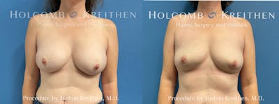 Breast Implant Removal Before & After Gallery - Patient 217308 - Image 1
