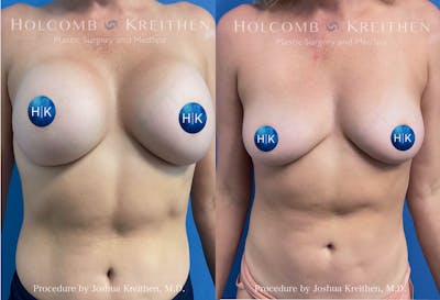 Breast Implant Removal Before & After Gallery - Patient 636854 - Image 1