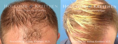 Neograft 2.0 Before & After Gallery - Patient 118411 - Image 1