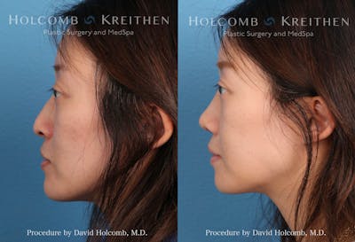 Rhinoplasty Before & After Gallery - Patient 630056 - Image 1