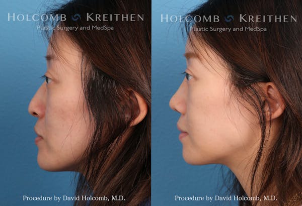 Rhinoplasty in Tampa Before & After Photos