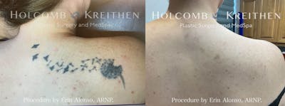 PicoPlus Tattoo Removal Before & After Gallery - Patient 186924 - Image 1