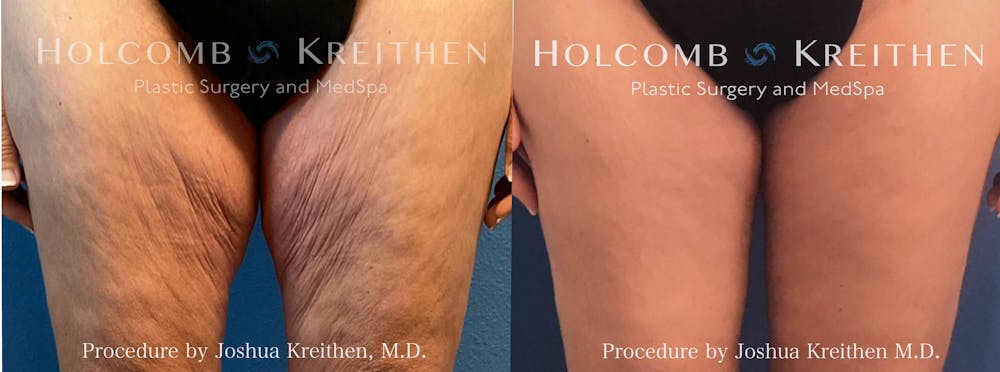 Thigh Lift Before & After Gallery - Patient 152590 - Image 1