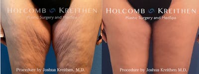 Thigh Lift Before & After Gallery - Patient 152590 - Image 1
