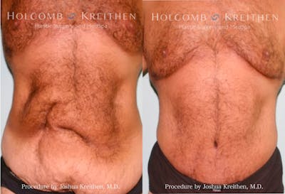 Tummy Tuck Before & After Gallery - Patient 187789 - Image 1