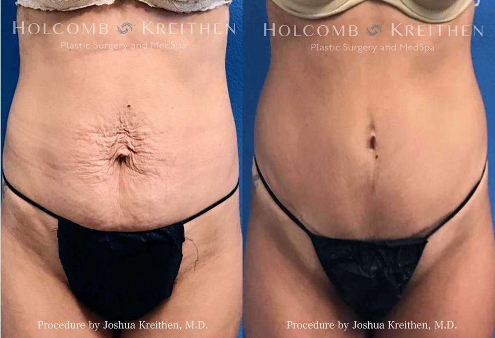 Tummy Tuck