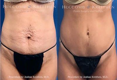 Tummy Tuck Before & After Gallery - Patient 240927 - Image 1