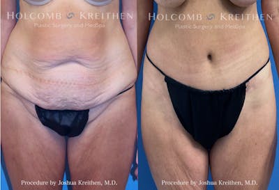 Tummy Tuck Before & After Gallery - Patient 191126 - Image 1