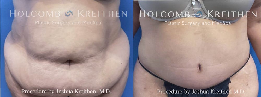 Tummy Tuck Before & After Gallery - Patient 370835 - Image 1