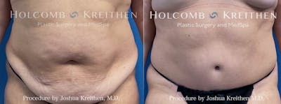 Tummy Tuck Before & After Gallery - Patient 421548 - Image 1