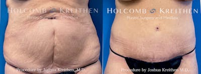Tummy Tuck Before & After Gallery - Patient 300859 - Image 1