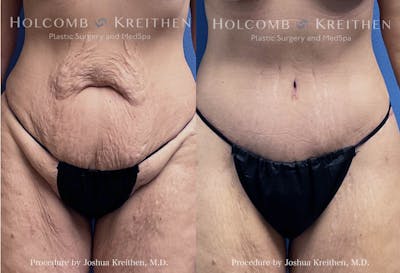 Tummy Tuck Before & After Gallery - Patient 141041 - Image 1