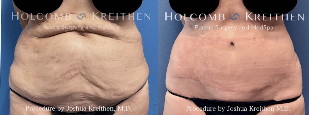 Tummy Tuck Before & After Gallery - Patient 158513 - Image 1