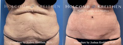 Tummy Tuck Before & After Gallery - Patient 158513 - Image 1