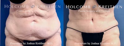 Tummy Tuck Before & After Gallery - Patient 429240 - Image 1
