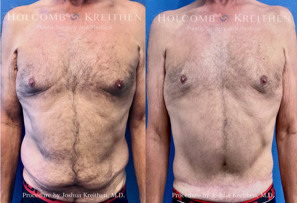 Tummy Tuck Before & After Gallery - Patient 356826 - Image 1