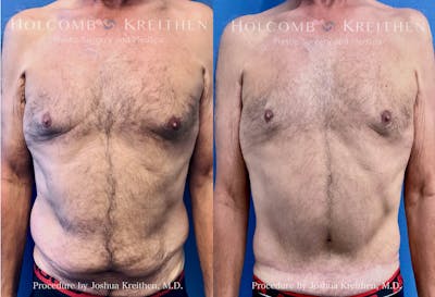 Tummy Tuck Before & After Gallery - Patient 356826 - Image 1