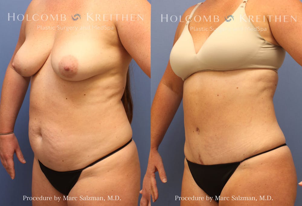 Tummy Tuck Before & After Gallery - Patient 325466 - Image 2