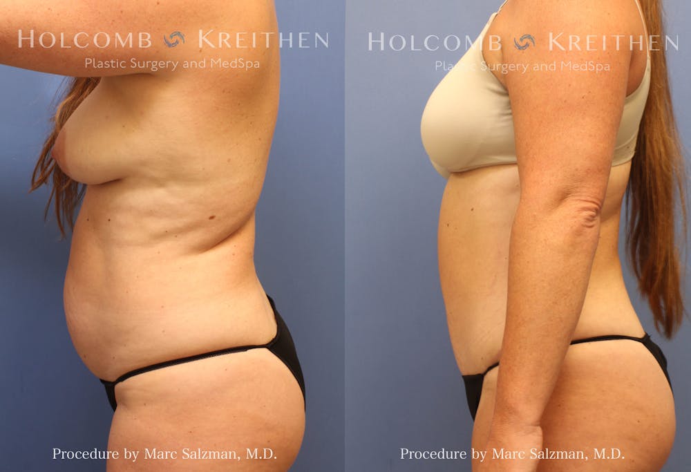 Tummy Tuck Before & After Gallery - Patient 325466 - Image 3