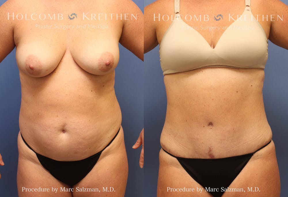Tummy Tuck Before & After Gallery - Patient 325466 - Image 1