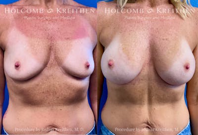 Breast Augmentation Before & After Gallery - Patient 401566 - Image 1