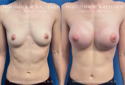Breast Augmentation Before & After Gallery - Patient 164720 - Image 1