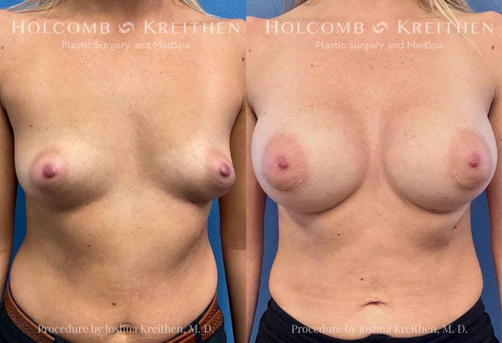 Breast Augmentation Before & After Gallery - Patient 118239 - Image 1