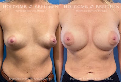 Breast Augmentation Before & After Gallery - Patient 118239 - Image 1