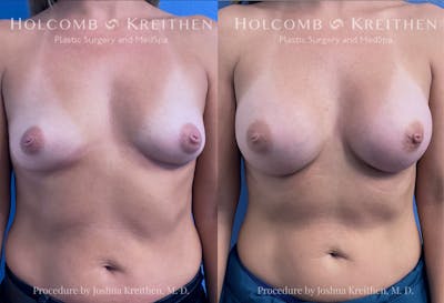 Breast Augmentation Before & After Gallery - Patient 319309 - Image 1