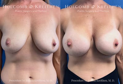 Breast Augmentation Before & After Gallery - Patient 963956 - Image 1