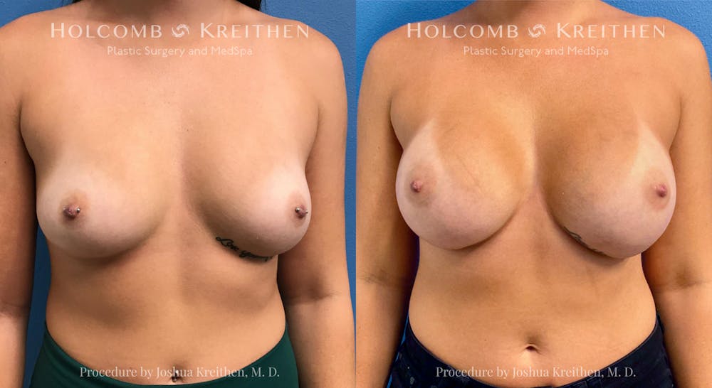 Breast Augmentation Before & After Gallery - Patient 238414 - Image 1
