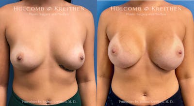 Breast Augmentation Before & After Gallery - Patient 238414 - Image 1