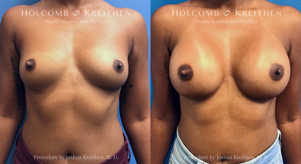 Breast Augmentation Before & After Gallery - Patient 415564 - Image 1