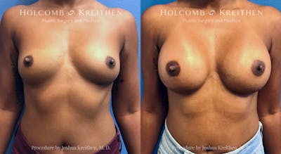 Breast Augmentation Before & After Gallery - Patient 415564 - Image 1
