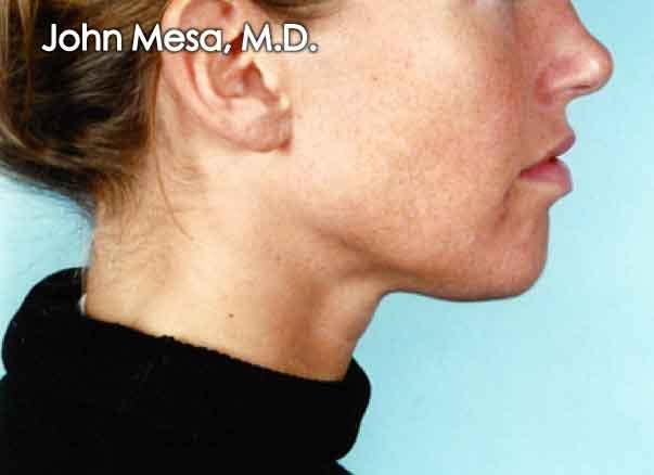 Chin Augmentation with Implant Before & After Gallery - Patient 6371243 - Image 1