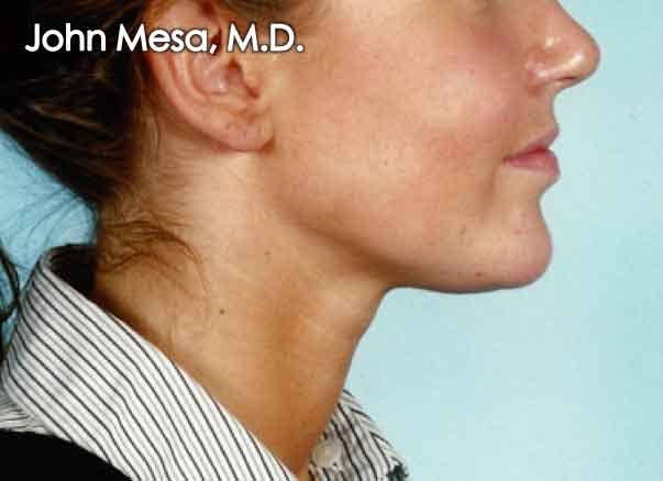 Chin Augmentation with Implant Before & After Gallery - Patient 6371243 - Image 2