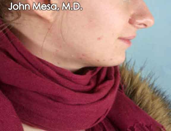 Chin Augmentation with Implant Before & After Gallery - Patient 6371244 - Image 1