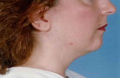 Chin Augmentation with Implant Gallery - Patient 6371245 - Image 1