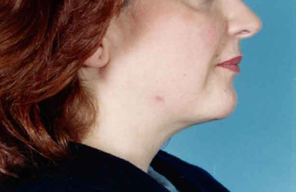 Chin Augmentation with Implant Gallery - Patient 6371245 - Image 2