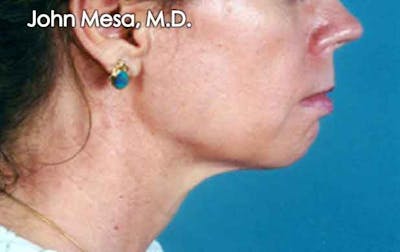 Chin Augmentation with Implant Before & After Gallery - Patient 6371247 - Image 1
