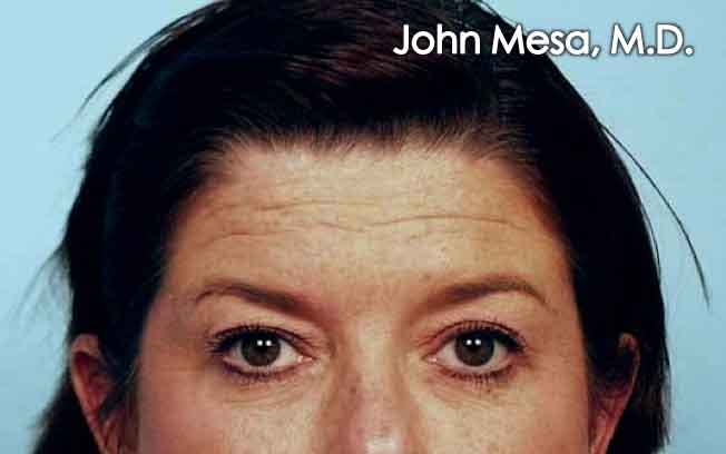 Endoscopic Brow Lift Before & After Gallery - Patient 6371299 - Image 1