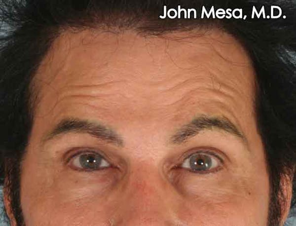 Endoscopic Brow Lift Before & After Gallery - Patient 6371300 - Image 1