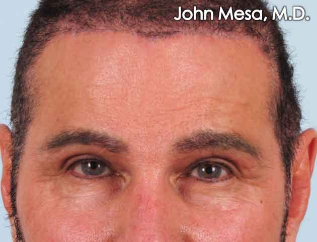 Endoscopic Brow Lift Before & After Gallery - Patient 6371300 - Image 2