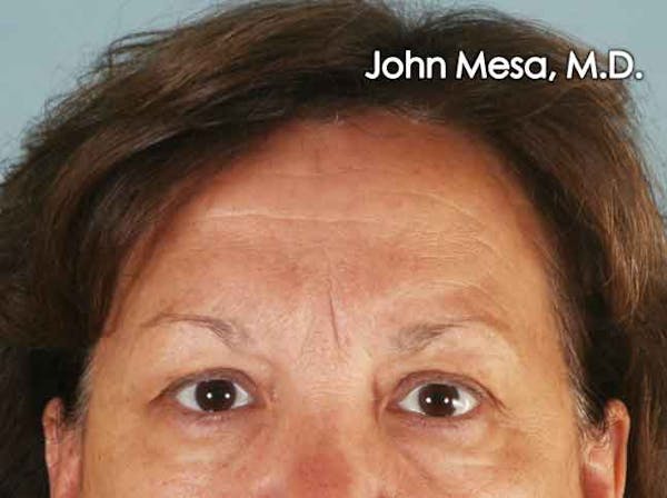 Endoscopic Brow Lift Before & After Gallery - Patient 6371302 - Image 1