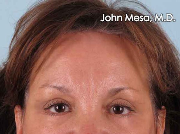 Endoscopic Brow Lift Gallery - Patient 6371302 - Image 2