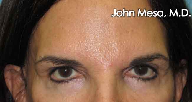 Endoscopic Brow Lift Before & After Gallery - Patient 6371303 - Image 1