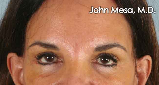 Endoscopic Brow Lift Gallery - Patient 6371303 - Image 2